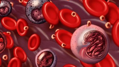 Скритите симптоми на левкемия, които лекарите могат да пропуснат