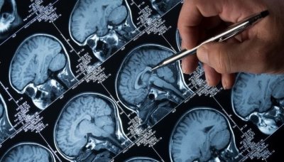 Изкуствен интелект открива скрити мозъчни малформации при деца с епилепсия