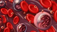Скритите симптоми на левкемия, които лекарите могат да пропуснат