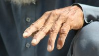 Два случая на проказа в Румъния: Затвориха СПА салон в Клуж-Напока
