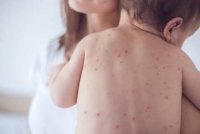 Увеличават се случаите на заразените с морбили
